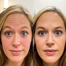 Botox Before and After Forehead (1)