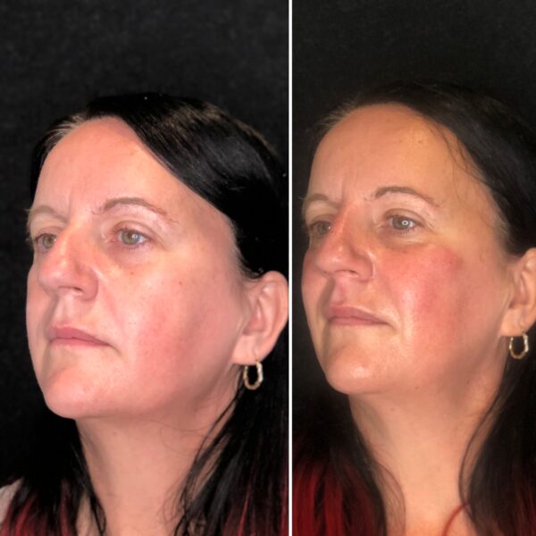 Cheek Enhancement Comparison
