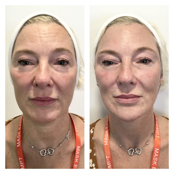 Cheek Filler Before After