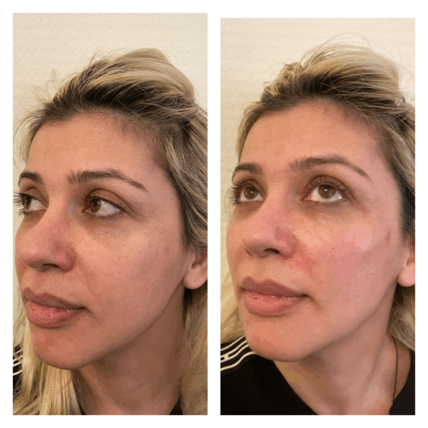 Cheek Filler Before After
