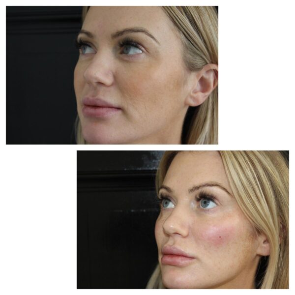 Cheek Filler Before and After (1)