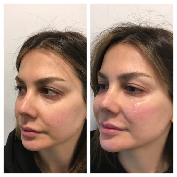 Cheek Filler Comparison by Dr. Emeagi