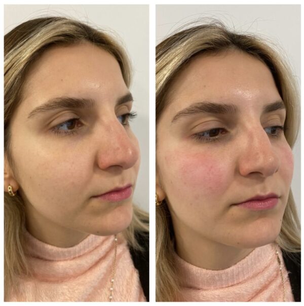 Cheek Filler Treatment by Dr. Emeagi