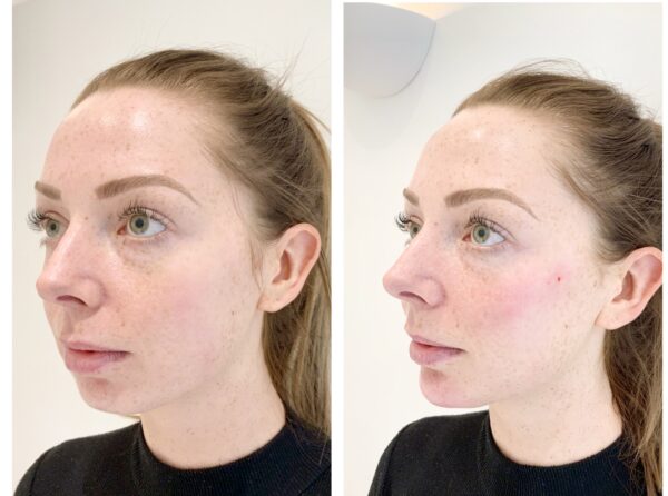 Chin Filler Before After