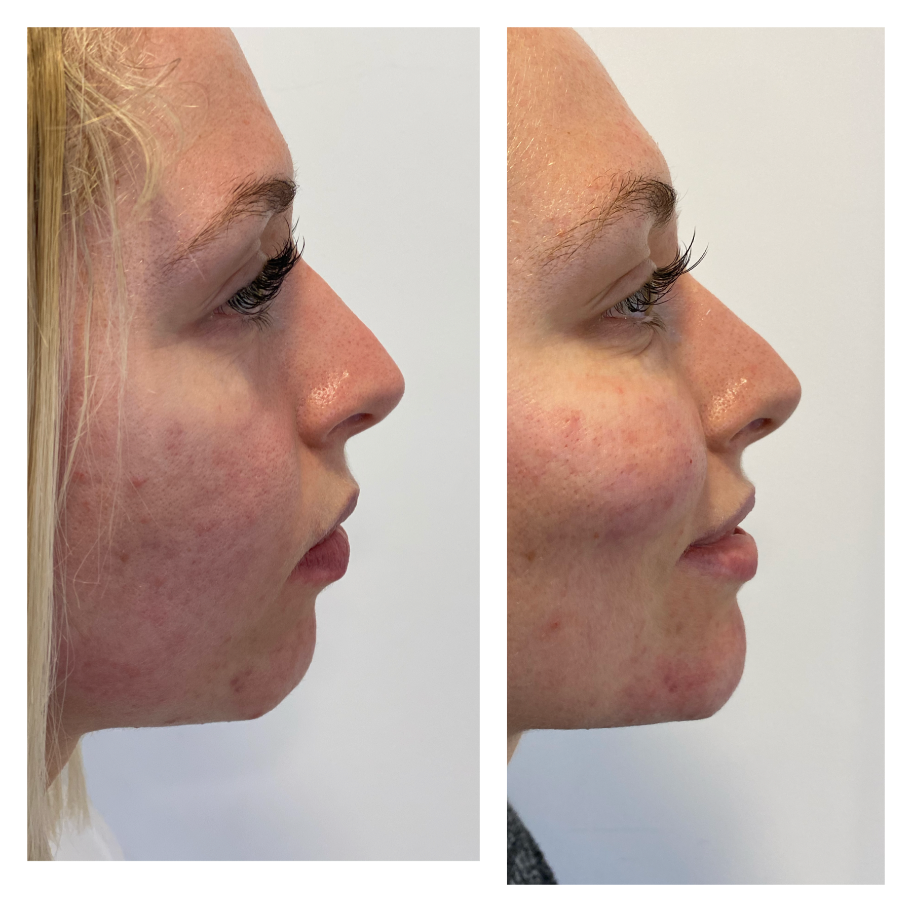 Chin Filler Before After Dr Emeagi