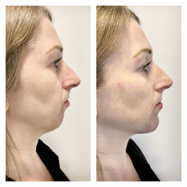 Chin Filler Side Profile