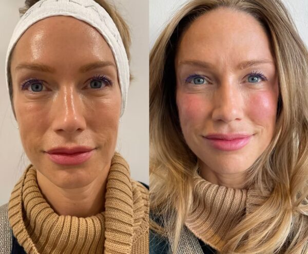 Dermal Fillers West Hampstead (1)