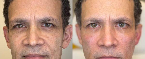 Dermal Fillers West Hampstead (2)