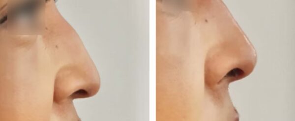 Dermal Fillers West Hampstead (3)