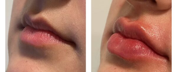 Dermal Fillers West Hampstead (4)