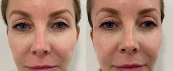 Dermal Fillers West Hampstead (5)