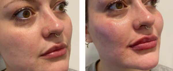 Dermal Fillers West Hampstead (6)