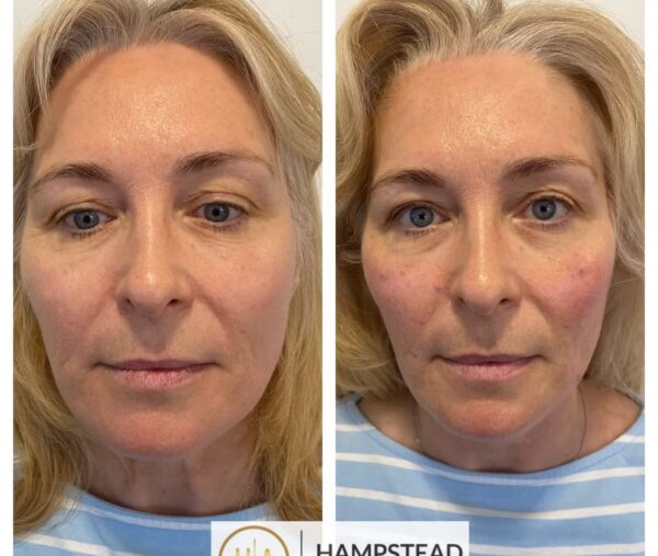 Jawline Thread Lift with PDO Threads