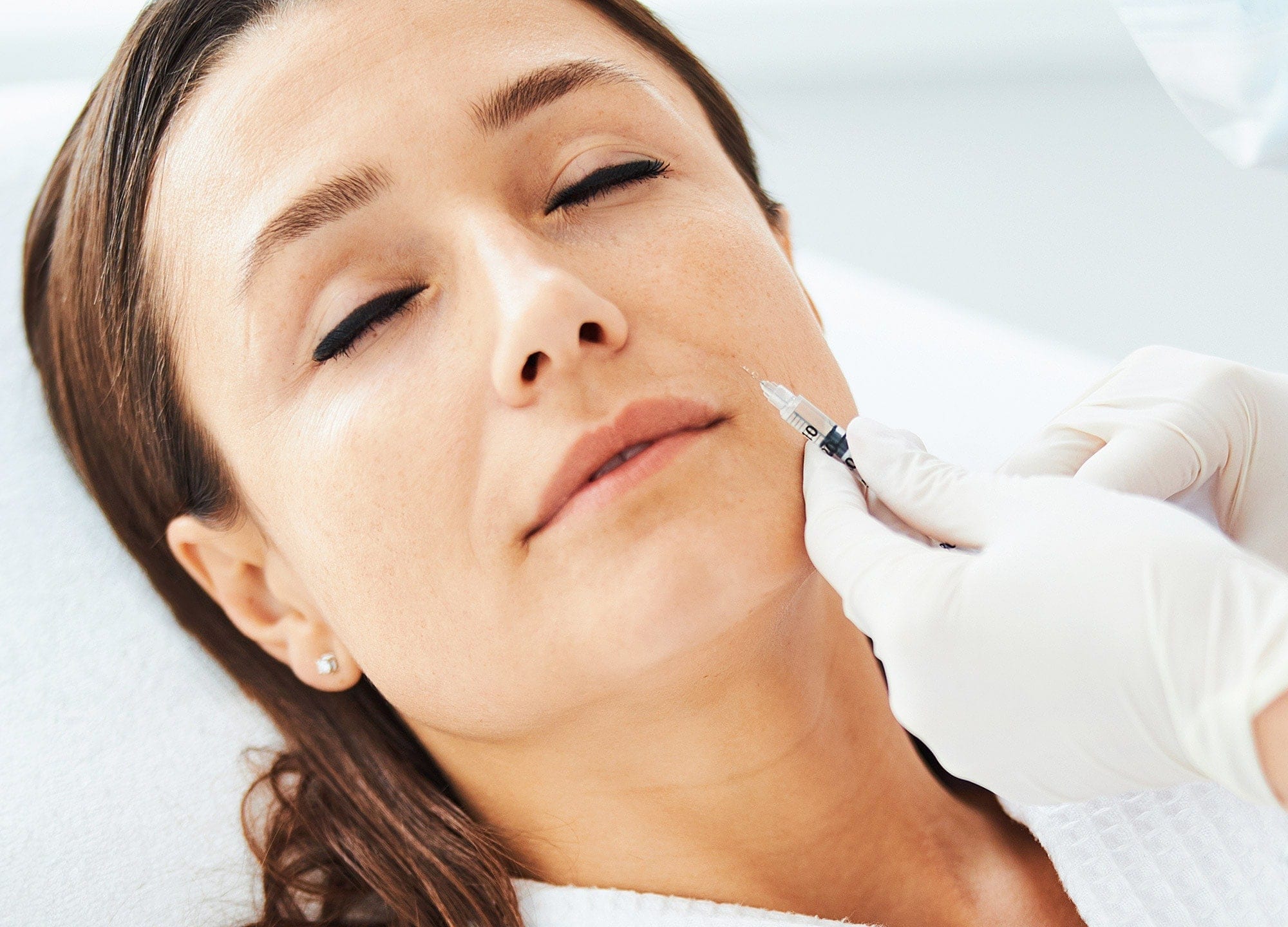 Nasolabial Fold Filler