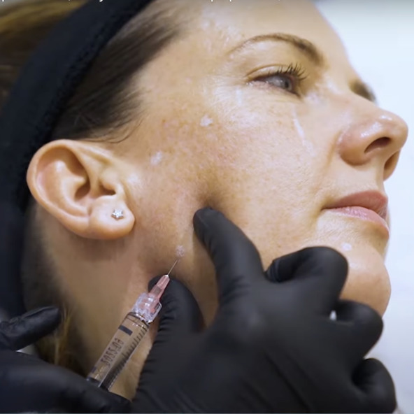 Skin Boosters