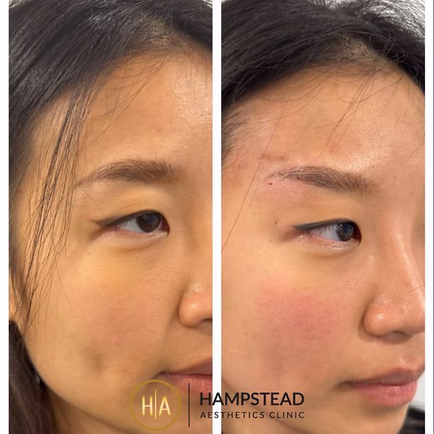 before and after pdo thread brow lift in London by Dr Chike Emeagi