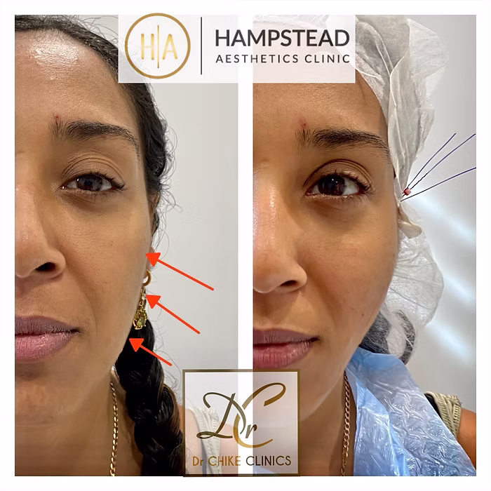 before and after pdo thread lift by dr chike emeagi