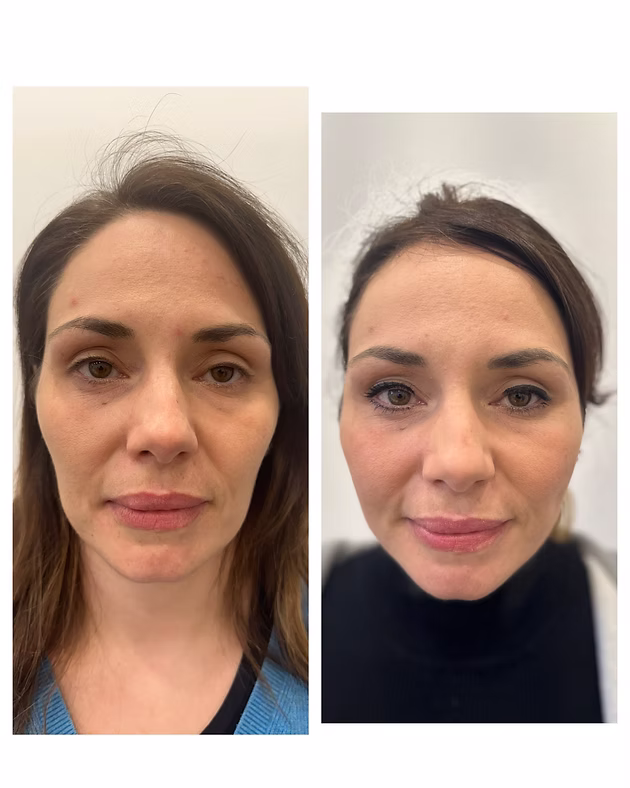 before and after pdo thread lift for jaw line and cheeks in London by dr chike emeagi