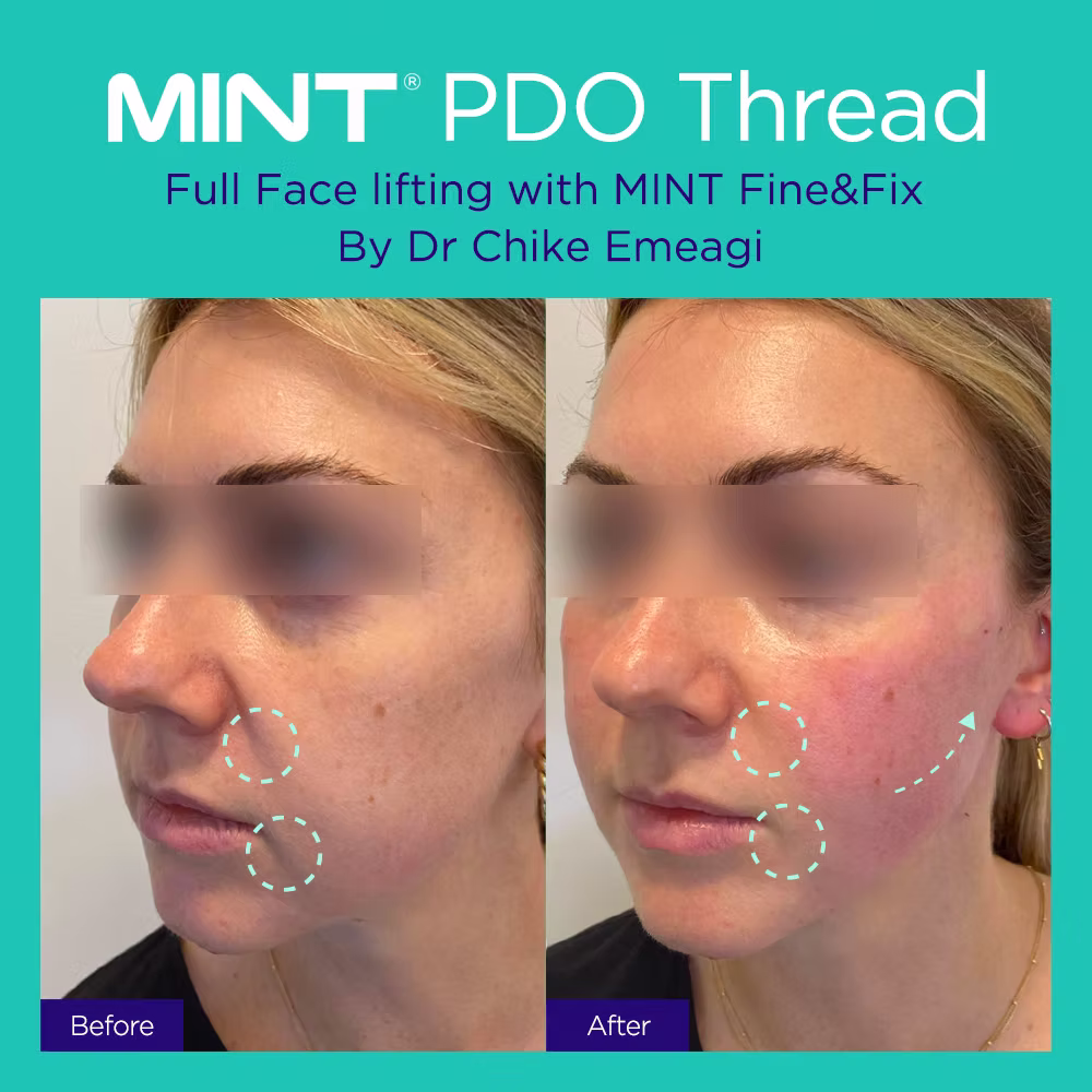 before and after pdo thread lift on cheeks and smile line in London by dr chike emeagi