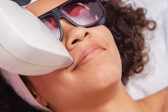 dark woman getting laser hair removal treatment on face