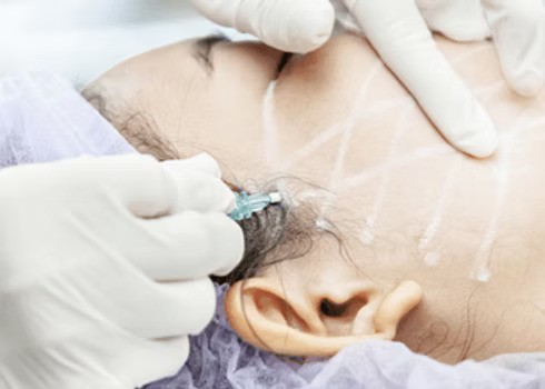 pdo thread lift contouring