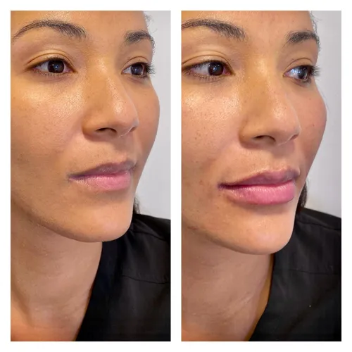 Before and after image of female patient. Side by side comparison following lip filler treatment with dr Chike Emeagi using Stylagedermal filler_