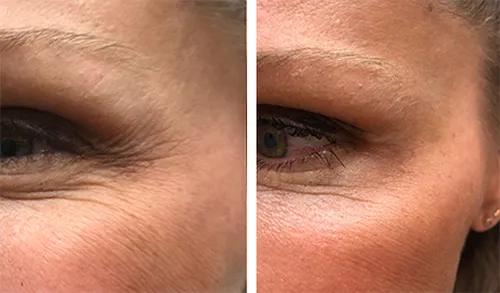 Botox before and after crows feet(1)