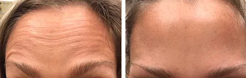 Botox before and after forehead and glabellar
