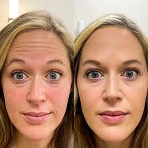 Botox before and after forehead