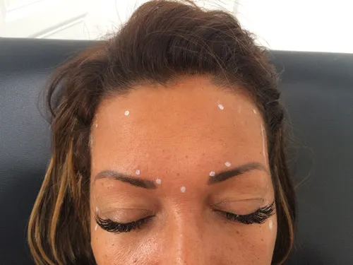 Botox injections marking up