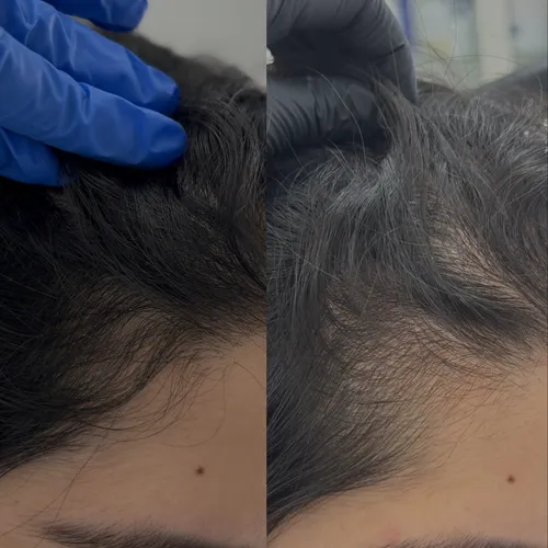 PRP Treatment for Hair Loss