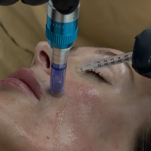 MICRONEEDLING CLOSE UP (1)