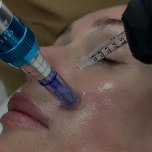 MICRONEEDLING CLOSE UP