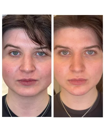 Masseter Botox beforeand after treatment by dr Chike Emeagi