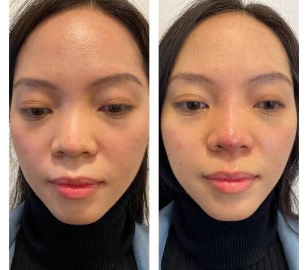 Nose Thread Lift London (1)