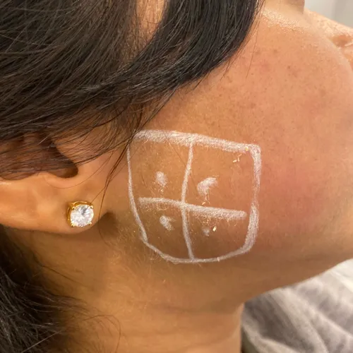 masseter botox prep