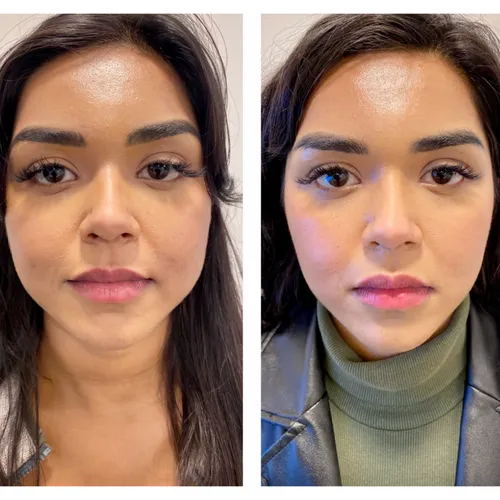 masseter botox treatment by dr chike emeagi before and after
