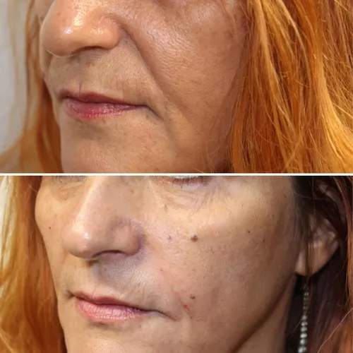 nasolabial fold filler treatment before and after using stylage dermal filler