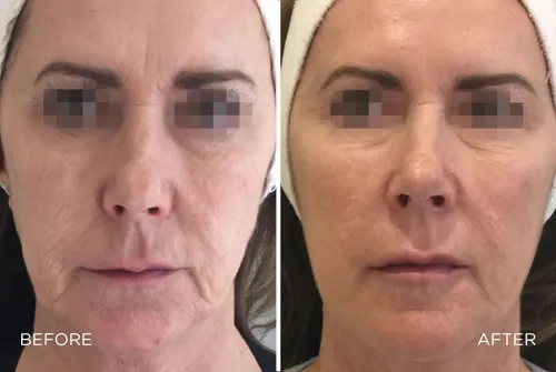profhilo before and after