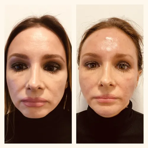 side by side comparison of female patient post PDO threadlift with dr chike emeagi using MINT PDO threads