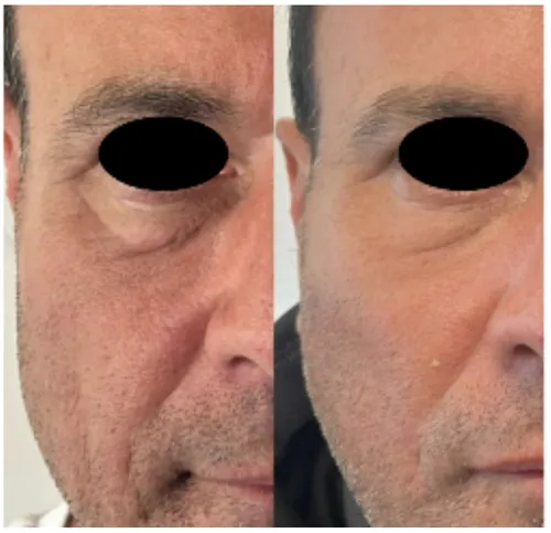 side byu side comparison of male patient post polynucleotides for under eyes treatment