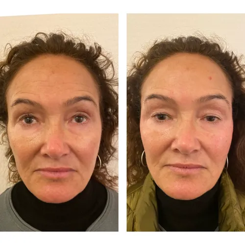 temple filler before and after treatmennt with dr chike using stylage dermal fillers