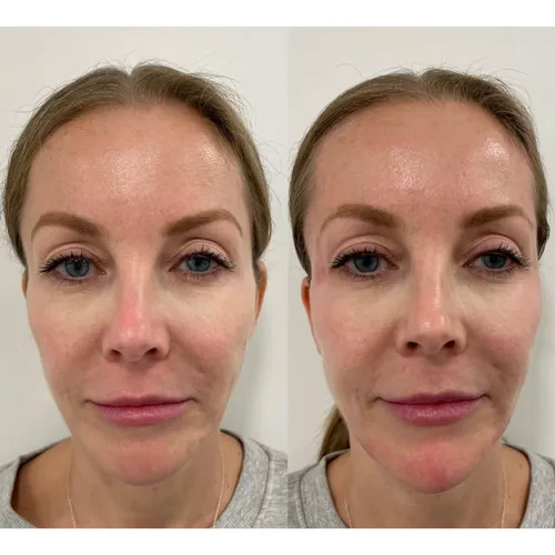 temple filler before and after using stylage dermal filler