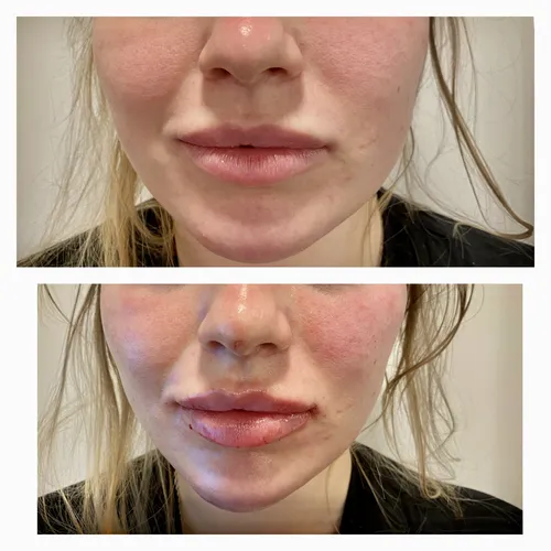 young female patient - Lip Filler before and after comparison by dr chike emegi using stylage dermal filler