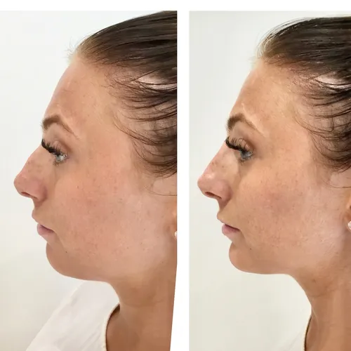 young female patient - side by side comparison following a non surgical rhinoplasty treatment by dr chike emeagi using stylage dermal filler