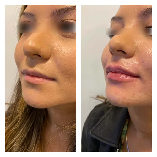 young female patient - side by side comparison of patient before and after lip filler treatment by dr chike emeagi using stylage dermal filler